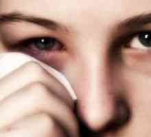 Alergický zápal spojiviek: liečba, príznaky, príčiny, príznaky