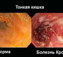 Crohnova choroba a ulcerózna kolitída