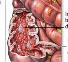 Toto ochorenie tenkého čreva Crohnova