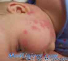 Diagnostika alergie a iné nežiaduce účinky liekov u detí