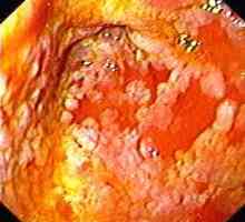 Gastritída sa črevná metaplázia