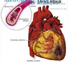Infarkt myokardu. Príčin úmrtí v infarkt myokardu