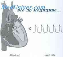 Zvýšenie srdcového výdaja. hypertrofia myokardu