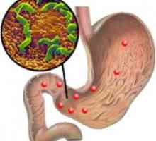 Erozívnej gastritídu a Helicobacter pylori