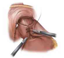 Chirurgická liečba refluxnej ezofagitídy a fundoplikace