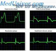 Akútnej fázy infarktu prednej steny. Infarkt myokardu zadnej steny na EKG