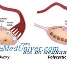 Polycystických vaječníkov. matný syndróm - Leventhal
