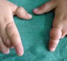 Syndróm amniotickej zúženie: príčiny, liečba