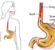 Syndróm refluxnej ezofagitídy