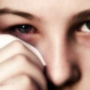 Alergický zápal spojiviek: liečba, príznaky, príčiny, príznaky