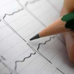 Srdcové arytmie, liečba, príčiny, príznaky, znaky