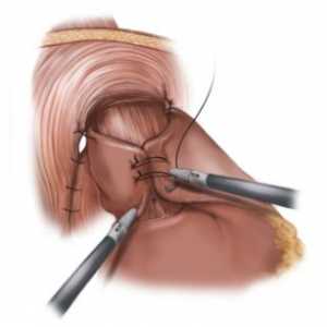 Chirurgická liečba refluxnej ezofagitídy a fundoplikace
