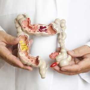 Komplikácie a prognóza Crohnovej choroby