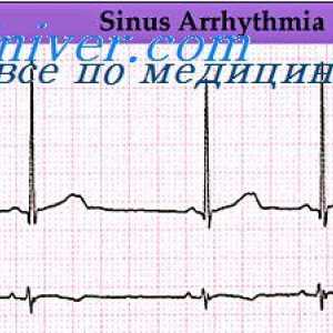 Srdcové arytmie. Porušenie rytmu sínusovom uzle